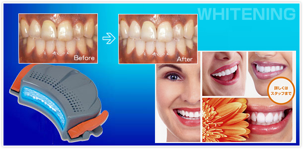当院では歯を白くするホワイトニングも行っています。ご相談ください。