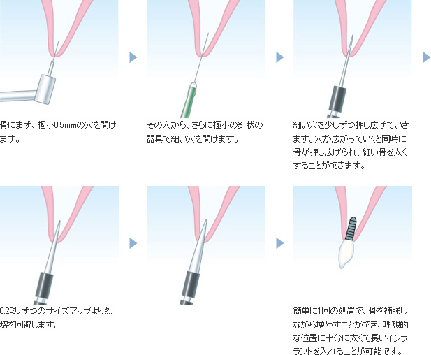 O.A.M.(大口式)インプラント法