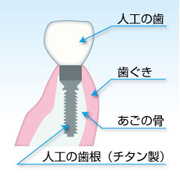 インプラント